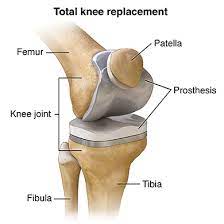 Knee Replacement $4500-$6500